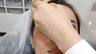 مناسب ترین نقاط صورت برای تزریق بوتاکس