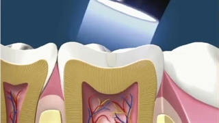 پر کردن آمالگام سفید  09198226524