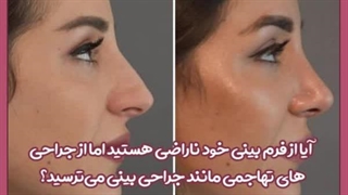 ماندگاری لیفت بینی با نخ چقدر است؟ لیپوست