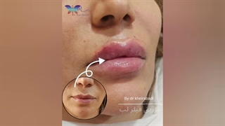 نمونه‌ای از تزریق فیلر لب (3)