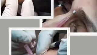 مزیت های لیفت صورت بدون جراحی چیست؟ اصلاح طرح لبخند