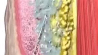 مزایای عمل لیپوساکشن 360 درجه