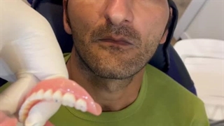 فیلم دندان مصنوعی برای افراد جوان 09198226524