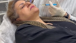 مزونیدلینگ صورت