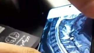 جراحی موفق ستون فقرات