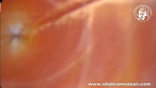 مرحله به مرحله کله سیستکتومی لاپاروسکوپیک