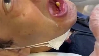 فیلم گذاشتن دندان مصنوعی متحرک