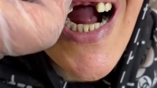 فیلم گذاشتن دندان مصنوعی در دهان