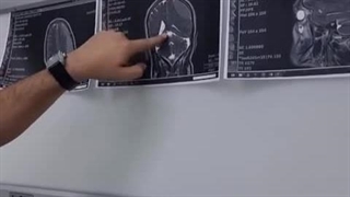 خون ریزی مغزی