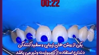 آیا کامپوزیت باعث بوی بد دهان میشود؟