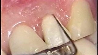 نمونه کیفیت ویدیوهای کتاب اندودانتیکس ترابی نژاد: اصول و تمرین ویرایش پنجم - 2015