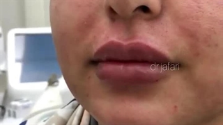 دکتر محمود جعفری.دکتر تزریق ژل لب ساری ماموپلاستی