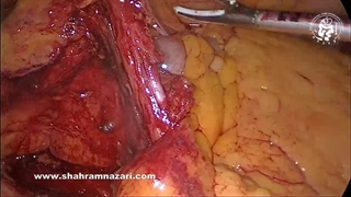 کولکتومی سمت راست لاپاروسکوپیک (برای سرطان سکوم روده بزرگ)