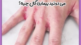 بیماری پوستی گال چیست؟