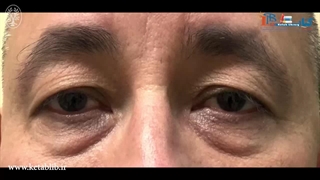 نمونه کیفیت ویدیوهای کتاب جراحی پلاستیک چشم ناحیه فوقانی صورت ویرایش اول - 2020