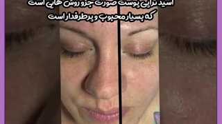 عوارض اسید تراپی صورت عصب‌کشی