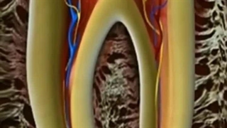 فیلم عصب کشی دندان