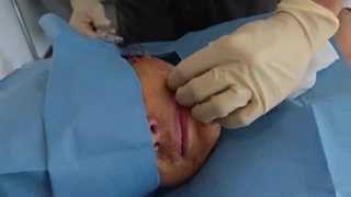 لیپوماتیک غبغب