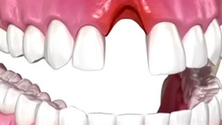 درمان تحلیل لثه با پیوند بافت نرم