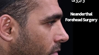 عمل پیشانی ناندرتال یا پیشانی برجسته