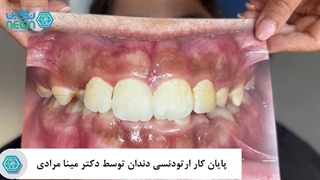 پایان کار درمان ارتودنسی دندان در کلینیک دندانپزشکی نگین - دکتر مینا مرادی لیفت ابرو