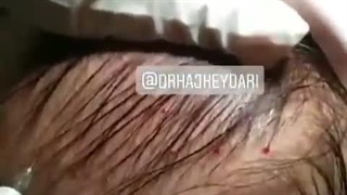 زهره حاج حیدری متخصص پوست ساری لیفت پیشانی