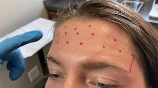 ویدئویی از مراحل انجام بوتاکس