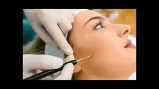 برداشتن خال