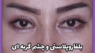 آیا میتوان عمل بلفاروپلاستی و چشم گربه ای را همزمان انجام داد؟