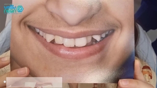 ویدیو پایان کار درمان ارتودنسی دندان - کلینیک دندانپزشکی نگین