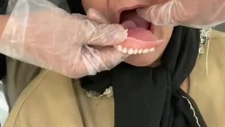 نظرات در مورد دندان مصنوعی