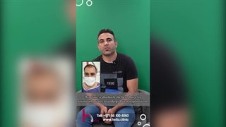 Stunning results 2 years after hair transplant