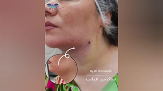 نمونه‌ای از رفع غبغب (1)