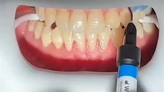 بیلیچینگ دندان در کلینیک قلهک