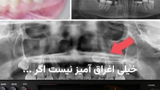 دندان نیش کلید زیبایی  فک  (پادکست)