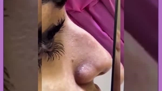 حالت دهی بینی بدون جراحی