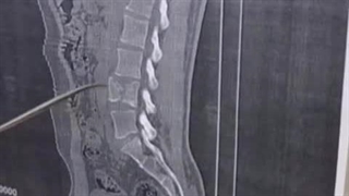 تصادف شدید مرد جوان با شکستگی کمر