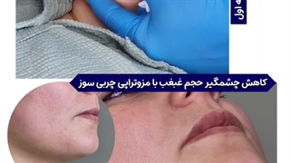 بهترین مرکز درمان و رفع غبغب در فردیس کرج