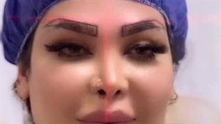 کاشت طبیعی ابرو به روش اس یو تی