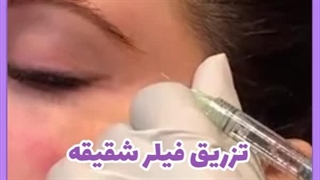 ورم بعد از تزریق ژل شقیقه