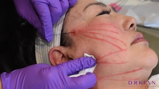 ویدئویی از چگونگی انجام لیفت صورت