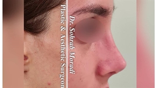 قبل و بعد عملیة تجمیل الأنف