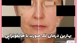 آیا هایفو لک صورت را از بین می برد؟ جراحی بینی