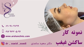 نمونه کار ساکشن غبغب