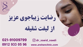 رضایت زیباجوی عزیز از لیفت شقیقه