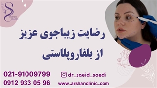 رضایت زیباجوی عزیز از بلفاروپلاستی