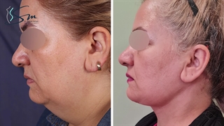 رفع الرقبة - أفضل جراح تجمیل فی طهران