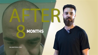 مشاهده نتیجه کاشت مو بعد از گذشت 8 ماه