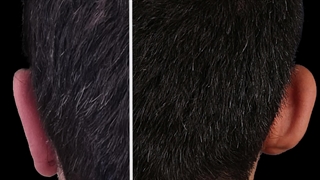 رأب الأذن (جراحة تجمیل الأذن)