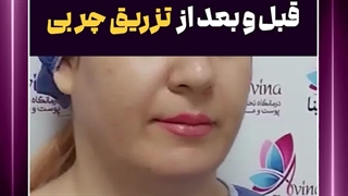 قبل و بعد از تزریق چربی پریودنتیکس
